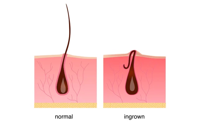 Waxing dan Kemungkinan Timbulnya Ingrown Hair